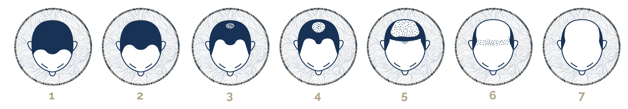 The different stages of male pattern hair loss Image